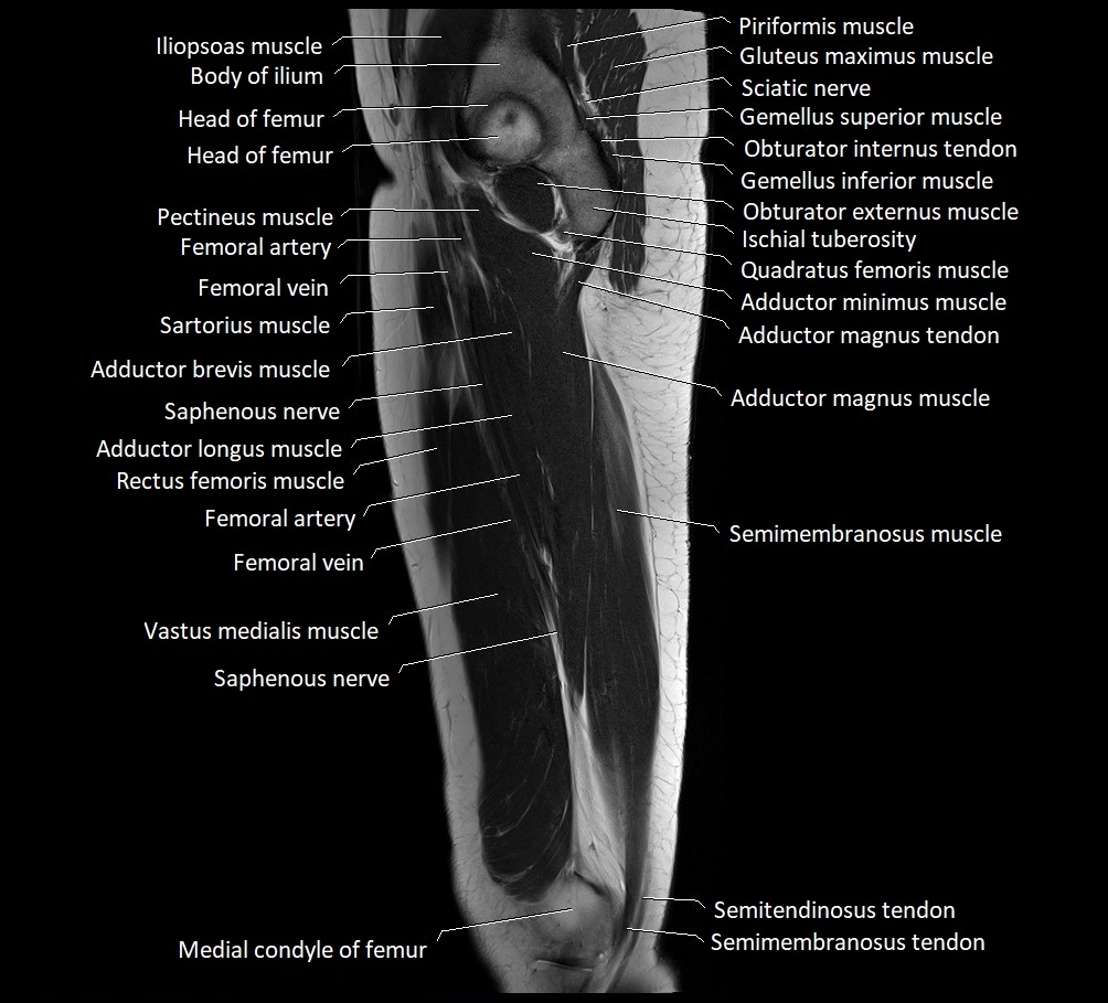 Thigh sagittal cross sectional anatomy MRI 3T image 14.webp